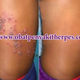 Illustration for article titled Cara Mengatasi Penyakit Herpes Secara Alami